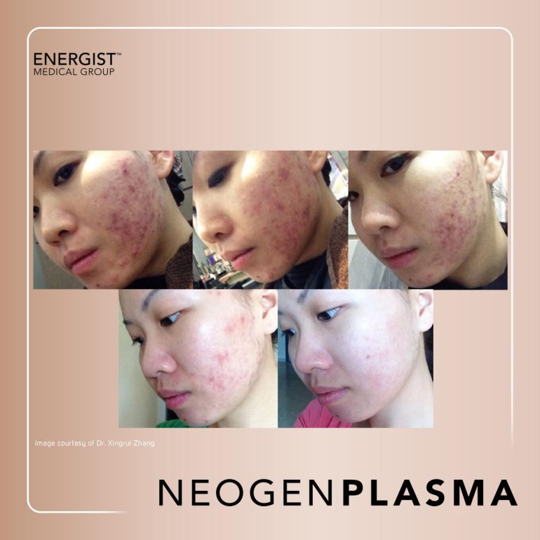 Acne Behandelen