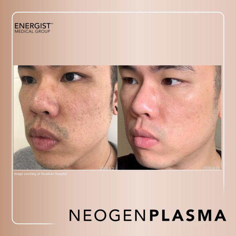 Neo-gen Acne