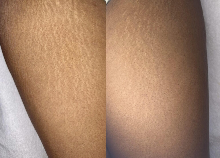Striae
